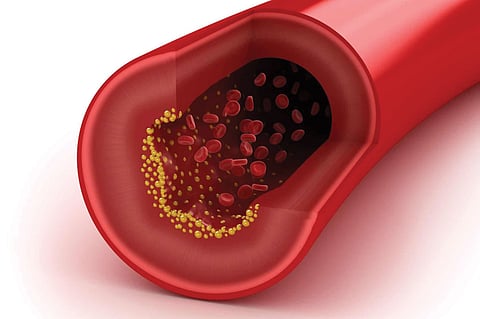 خبراء يوضّحون «الكوليسترول» الجيد والسيئ.. و3 نصائح للوقاية