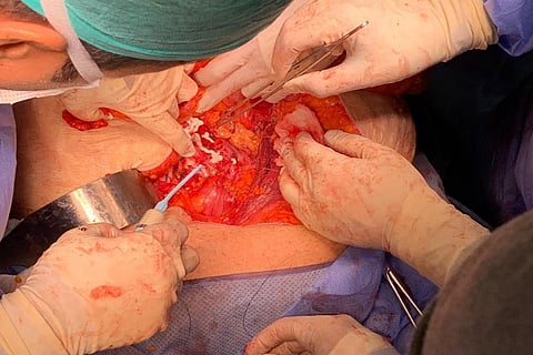 استغرقت 10 ساعات.. استئصال ورم سرطاني خبيث من سبعينية