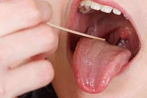 احذر.. حالة اللسان تُظهر أمراضًا خطيرة