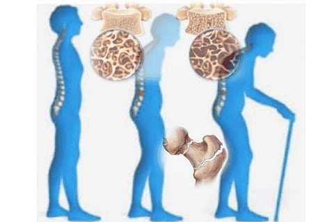 بالإنفوجراف.. أعراض مرض هشاشة العظام و4 طرق للوقاية منها