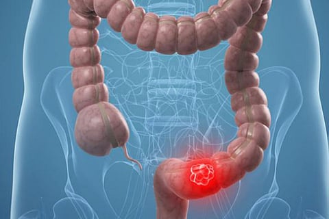 منظار المعدة يقي من سرطان القولون