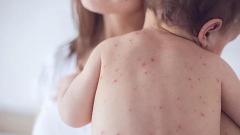 «الحصبة» تُنْسِي جهازك المناعي كيف يحارب الأمراض