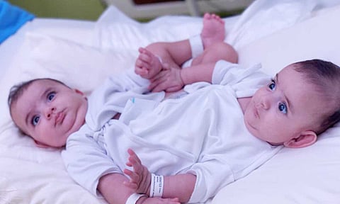 الربيعة يقود فريقًا من 35 مختصًا لفصل التوأم السيامي الليبي «أحمد ومحمد».. الخميس المقبل