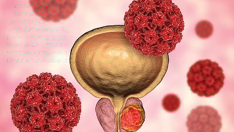بالأسماء.. تحذير من مواد غذائية تنشط «سرطان البروستاتا»