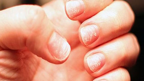 نقص الحديد.. أسبابه وأعراضه