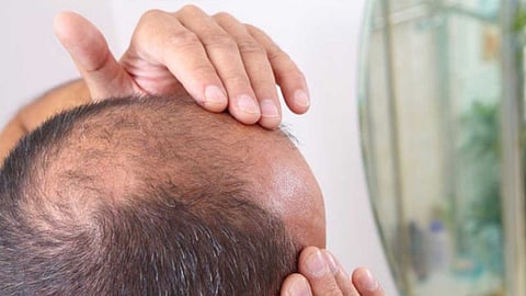 أسباب تطاير الشعر في الشتاء وسبل مواجهتها