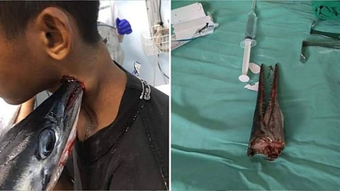 بالصور.. سمكة تقفز من الماء وتخترق رقبة شاب في إندونيسيا