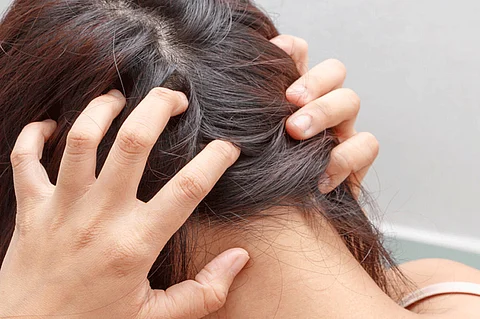 4 أسباب غذائية وصحية وراء «حكة» فروة الرأس