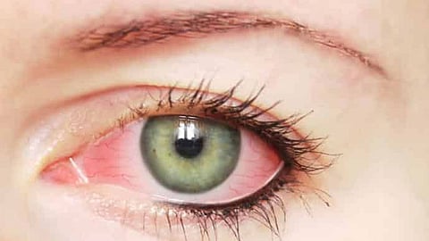 هذا الالتهاب يهددك بالعمى.. تعرف على أعراضه