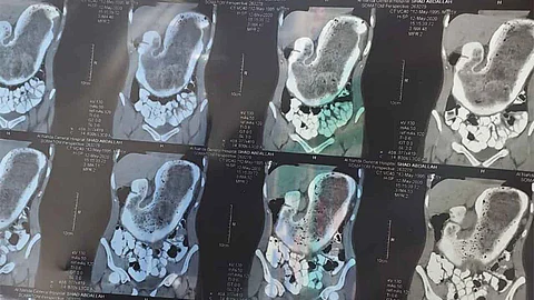 حالة طبية نادرة الحدوث.. إخراج 2 كيلو «شعر» من بطن فتاة بالطائف