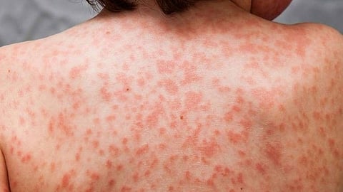 جرثومة «الريكتسيا» البكتيرية.. أعراضها وأمراضها وطريقة انتقالها