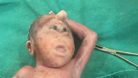 ولادة طفل مصري بعين واحدة في منتصف الرأس.. والطبيب يكشف السبب