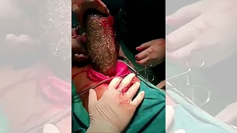 بتدخل جراحي.. إخراج 7 كيلوجرامات «شعر» من معدة فتاة مضغتها على مدار سنوات