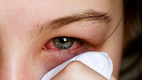 مفاجأة.. اكتشاف فيروس كورونا في عين امرأة ظهرت نتيجة اختبارها سلبية