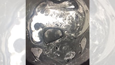 بدء العمل في جراحة أورام العظام والعضلات بمستشفى المدينة المنورة