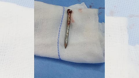 «مسمار» يهدد حياة عامل قبل تدخل طبي عاجل لإنقاذه بالطائف