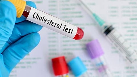 النمر: يجب تحليل الكوليسترول قبل استخدام دواء رواكيوتان