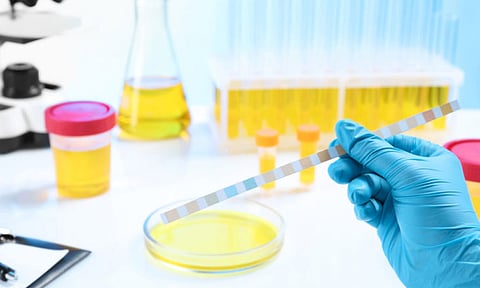 الكيتونات في البول.. علامة على الإصابة بمرض السكري النوع 2