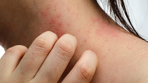 حساسية السمك.. قد تهدد الحياة في بعض الحالات