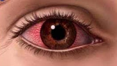 «الرمد الموسمي».. أعراضه وطرق العلاج منه