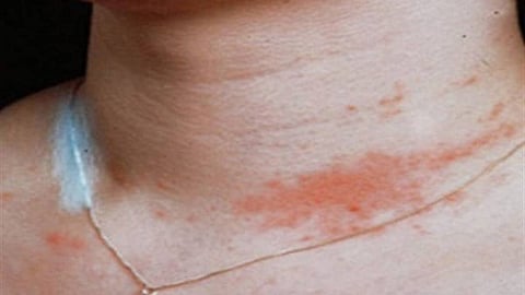 ماذا تعرف عن حساسية النيكل؟