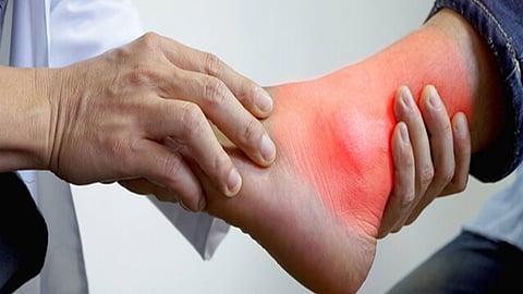 ما هو التهاب المفاصل الصدفي وما أعراضه وطرق علاجه؟