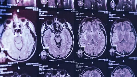 فقدان الذاكرة وهلوسات.. إصابة 43 شخصًا في كندا بمرض غامض في المخ