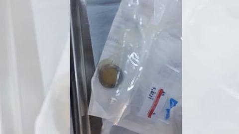 العملية استغرقت 5 دقائق.. استخراج قطعة نقود من بلعوم طفل بجدة