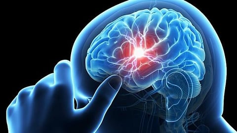 باحثون يطورون علاجًا جديدًا للسكتة الدماغية
