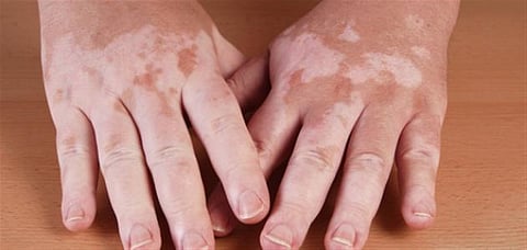 استشاري: صعوبة علاج بقع البهاق حال ابيضاض الشعر