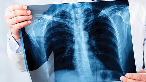 سرطان العظام.. الأسباب والأعراض