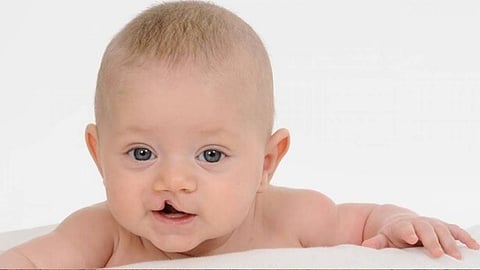 الرابطة الألمانية: 5 أضرار للشفة المشقوقة لدى الأطفال