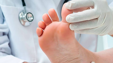 7 معلومات عن مرض «قدم شاركو» الناتج عن مضاعفات السكري