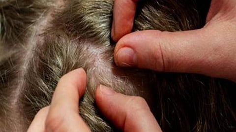 7 طرق ومواد للقضاء على حشرات الرأس بالأطفال