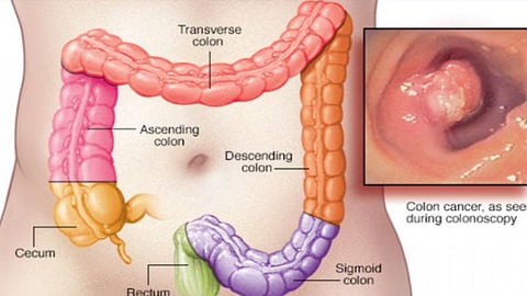 «الخضيري»: منظار القولون ضروري للأعمار فوق 50 عامًا كل 10 سنوات