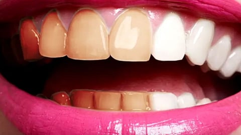 3 أطعمة تؤثر على لون الأسنان الطبيعي منها الكاتشب