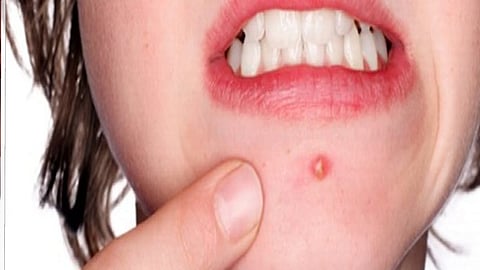 6 نصائح مفيدة للتخلص من البثور في الصيف