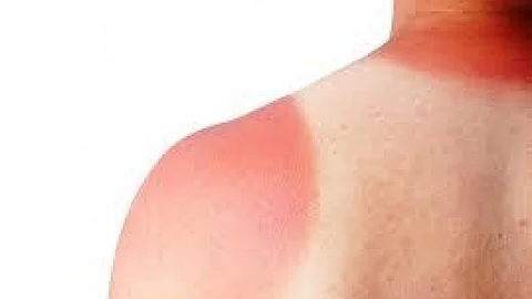 4 طرق بسيطة لعلاج حروق الشمس
