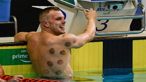 «الحجامة» تخطف الأنظار في الدورة الأولمبية