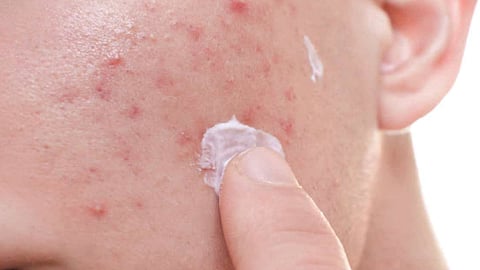 حب الشباب .. أسباب ظهوره وطرق هندية فعالة لمواجهته