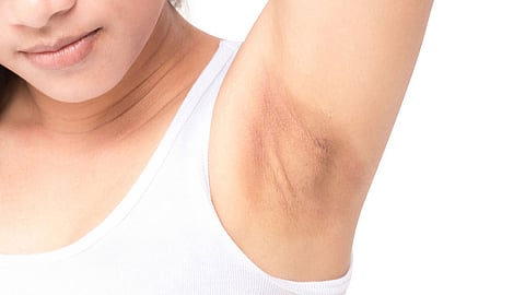 10 وصفات طبيعية لتفتيح سواد الإبط