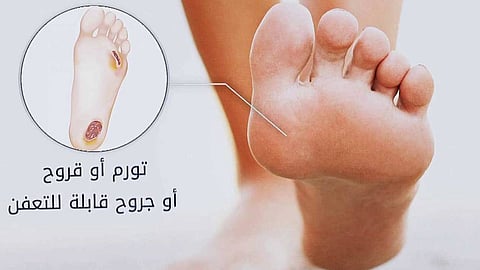 القدم السكري.. أعراضه وطرق علاجه والوقاية منه