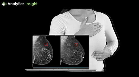 England to Launch Major AI Trial for Faster Breast Cancer Screening