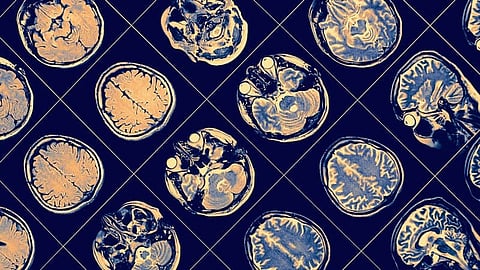 IBM Sets hope for Alzheimer’s Disease Diagnoses with Machine Learning