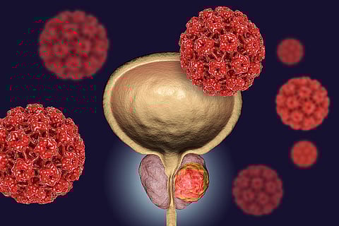 How AI is Helping to Detect Prostate Cancer