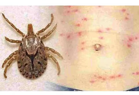 ஸ்க்ரப் டைபஸ் தொற்று