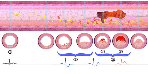 இதயத்துக்கு(ள்) இவ்வளவு சிக்கல்களா... 5 ஆண்டுகளில் 50% அதிகரிப்பு...!