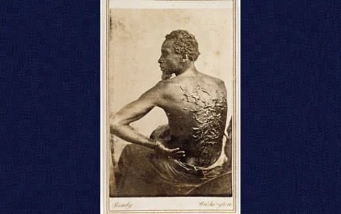 A photo taken in 1863 of a slave known only as “Peter”, showing severe scarring from whippings. This historical artifact may no longer be displayed to the public by US institutions.