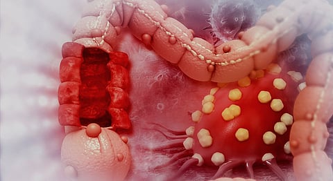 Colon cancer deaths unaffected by colonoscopies, study shows