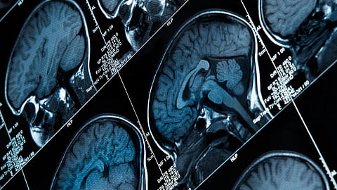 Ketogenic diet: A promising treatment for epilepsy